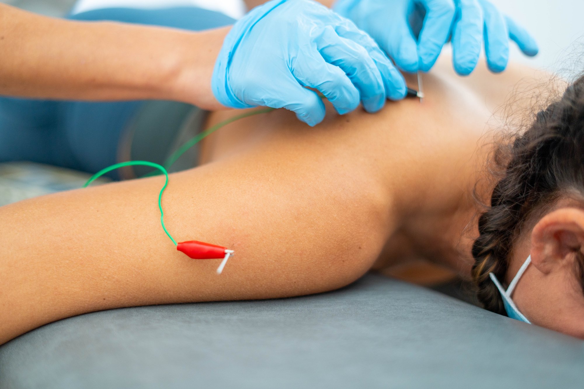 closeup-shot-of-a-doctor-putting-acupuncture-needl-2025-02-09-20-00-21-utc