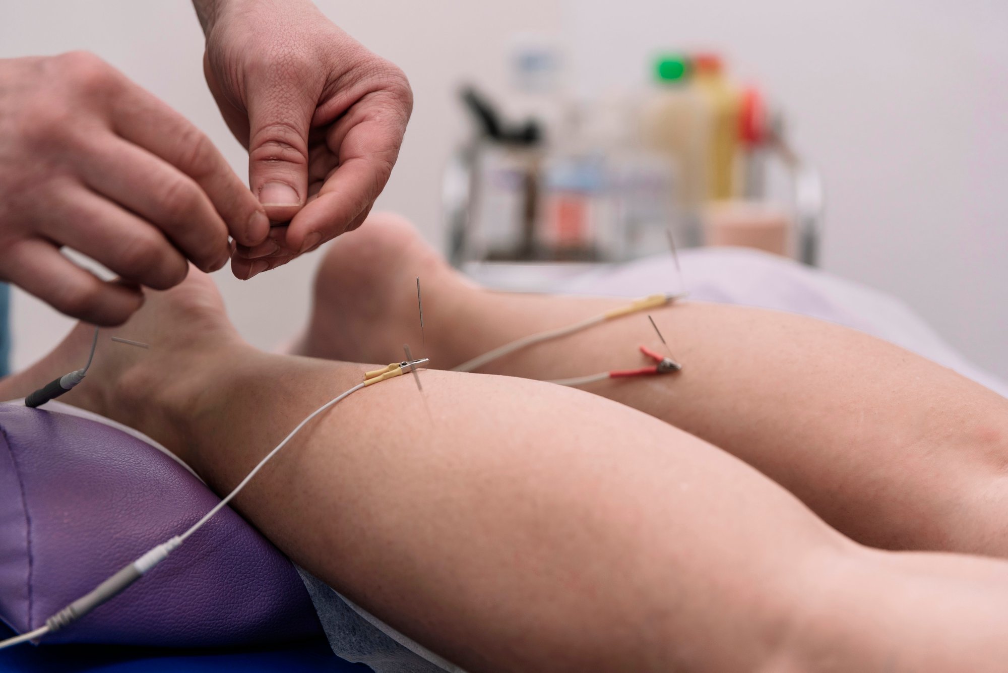 electrical-stimulation-in-physiotherapy-in-the-ph-2023-11-27-05-00-28-utc