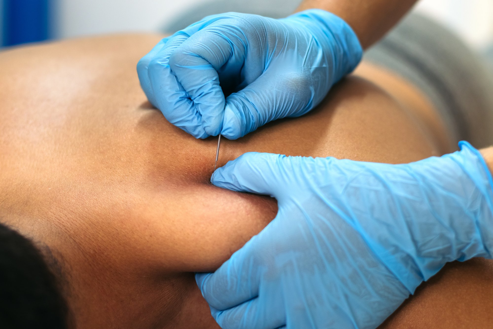 physiotherapy-clinic-dry-needling-2024-04-10-17-16-43-utc